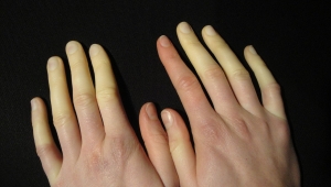 SOĞUK HAVALARIN SİNSİ HASTALIĞI RAYNAUD FENOMENİ