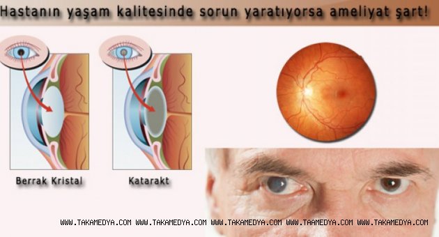 FAKO ile Katarakt'tan kurtulun
