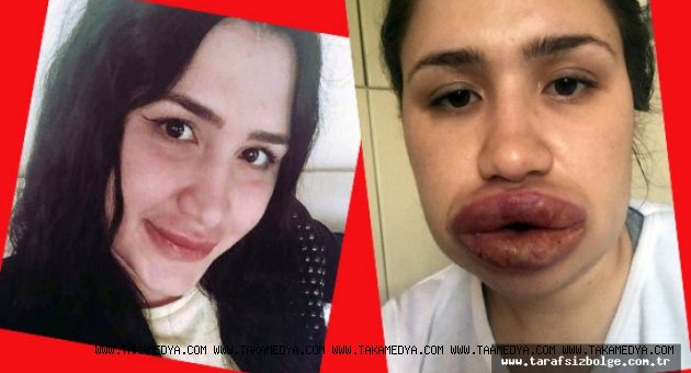 Silikon mağduru hemşire son halinin fotoğrafını paylaştı!